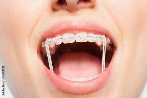 Obraz na plátně Woman mouth with orthodontic elastics on braces