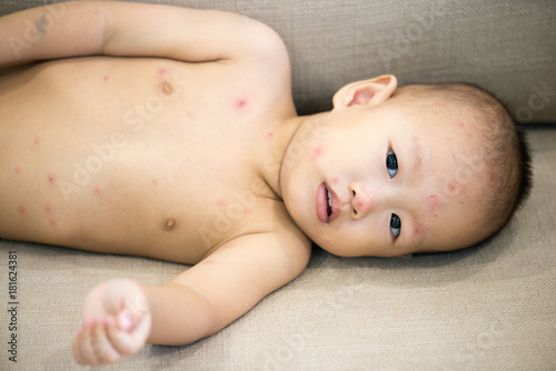 Baby boy with chicken pox lying on sofa
