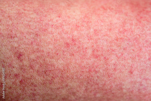 Skin with dengue fever red rashes