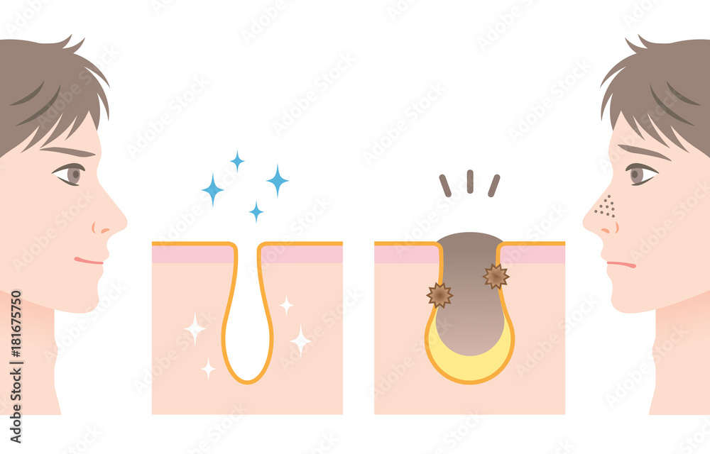 角栓除去images Browse 30 Stock Photos Vectors And Video Adobe Stock