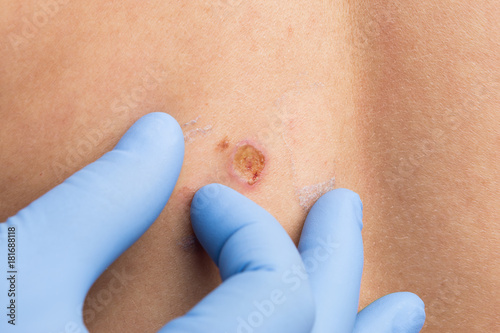 Mold removal concept with doctor hands examining the skin