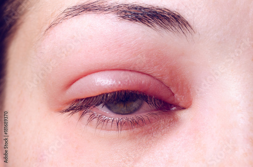 Barley infection on the eye photo