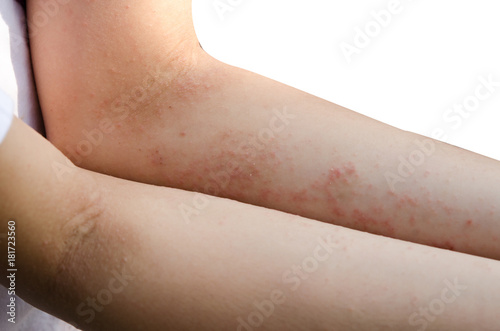 red rash on the arms photo
