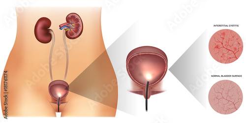 Urinary bladder examination, healthy lining and unhealthy inflamed lining with cystitis on a white background. Female silhouette and detailed urinary system.