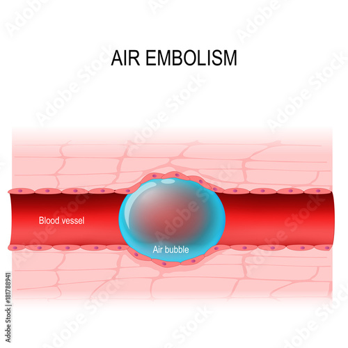 air embolism.
