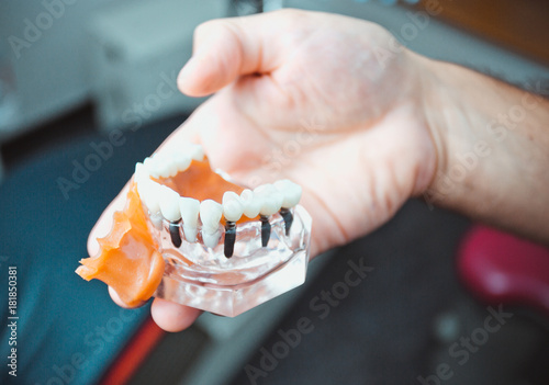 Dentist showing tooth plastic model with screw implant for teaching, learning and patients in dental office