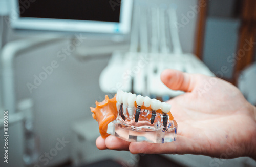 Dentist showing tooth plastic model with screw implant for teaching, learning and patients in dental office blurry background