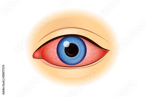 Eye redness symptom of human isolated on white. Illustration about health problem. 