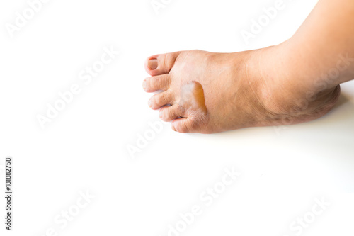 The scald on the foot skin caused by the boiling cooking oil © phichak