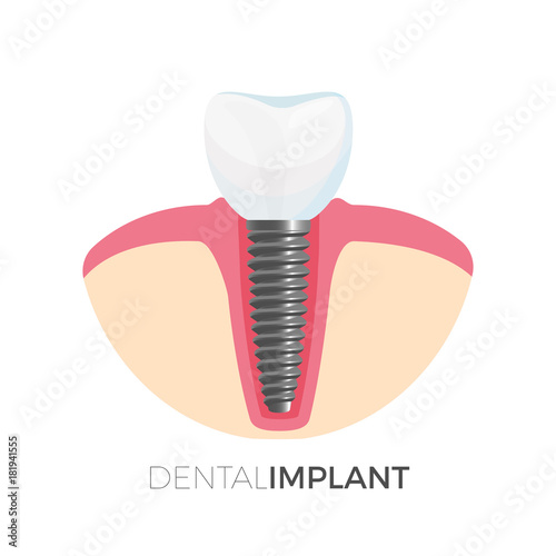 Dental implant poster with image on vector illustration