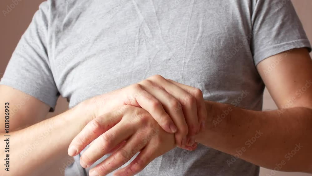 A man smears a sick hand with cream. Psoriasis and skin disease