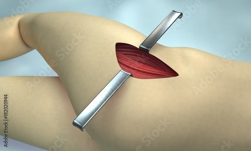 Hip surgery - medical 3d visualisation