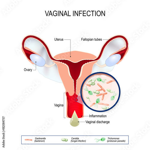 vaginal infection and causative agents of vulvovaginitis. photo