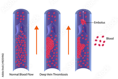 Thrombosis. Vector illustration
