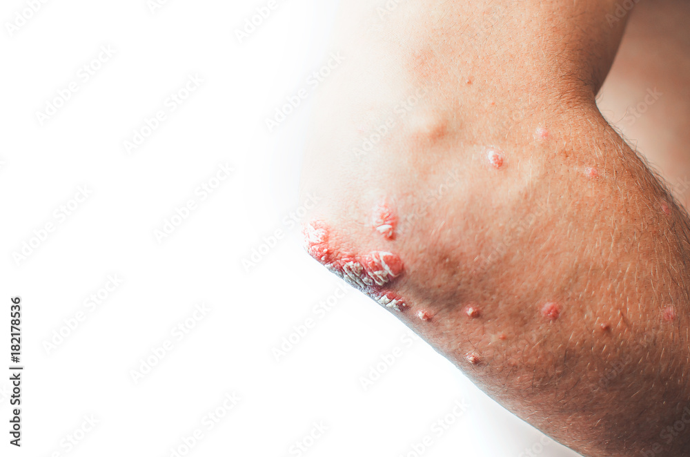 Fototapeta premium on the Elbows Psoriasis