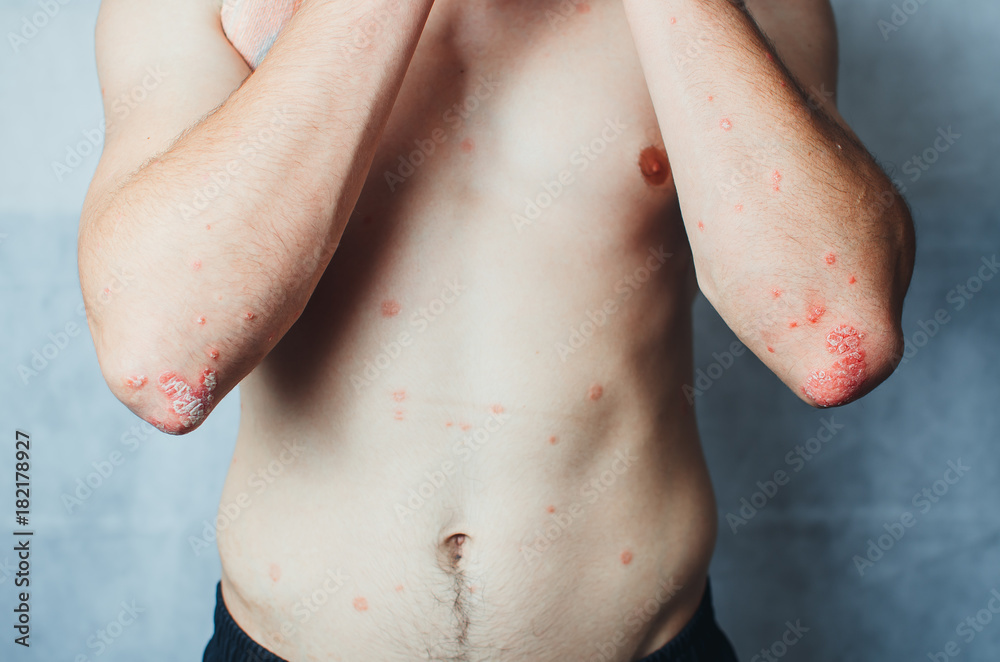 on the Elbows Psoriasis on the Elbows Psoriasis