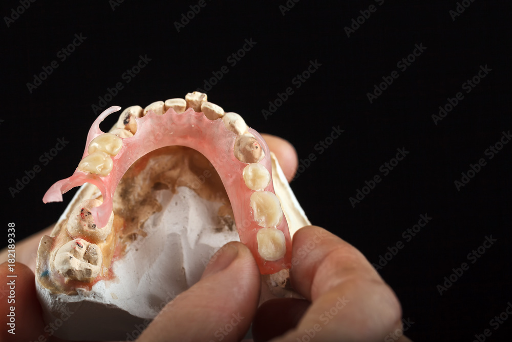 A denture on a gypsum base in the hand of a dentist.