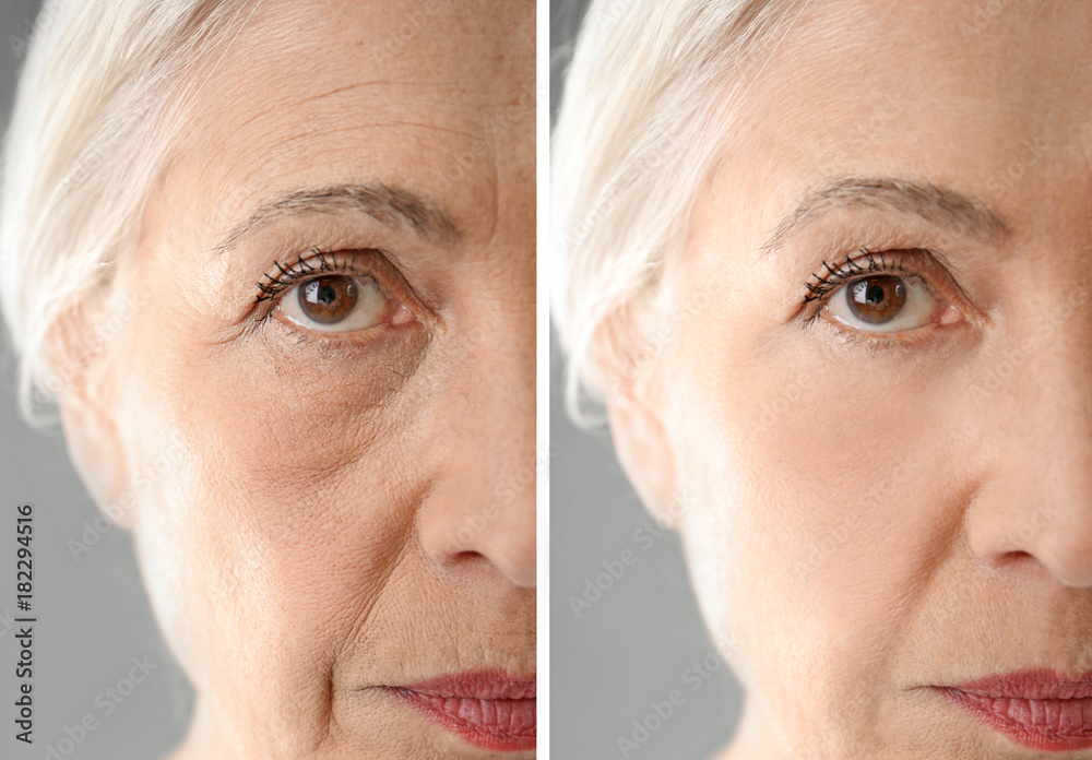 Senior woman before and after biorevitalization procedure, closeup