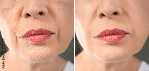 Senior woman before and after biorevitalization procedure, closeup photo