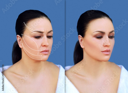 Fotografie Thread Lift ,markup