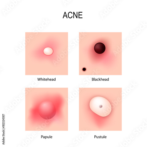 Acne vulgaris. stages of development. Types of pimples.