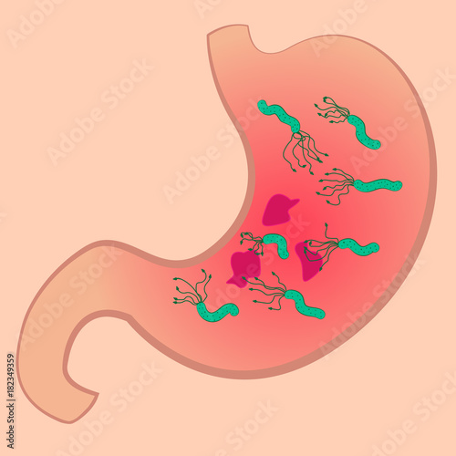 A Stomach with ucler and Helicobacter pylori photo