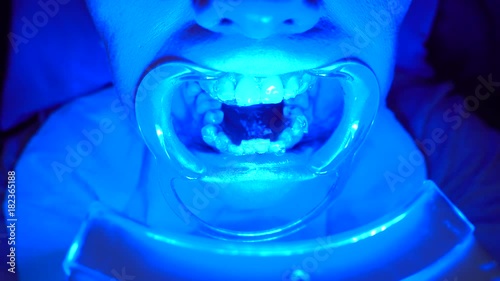 Close-up of special equipment whitening the teeth of a young woman with a tooth holder