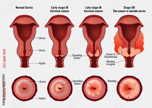 Cervical cancer image