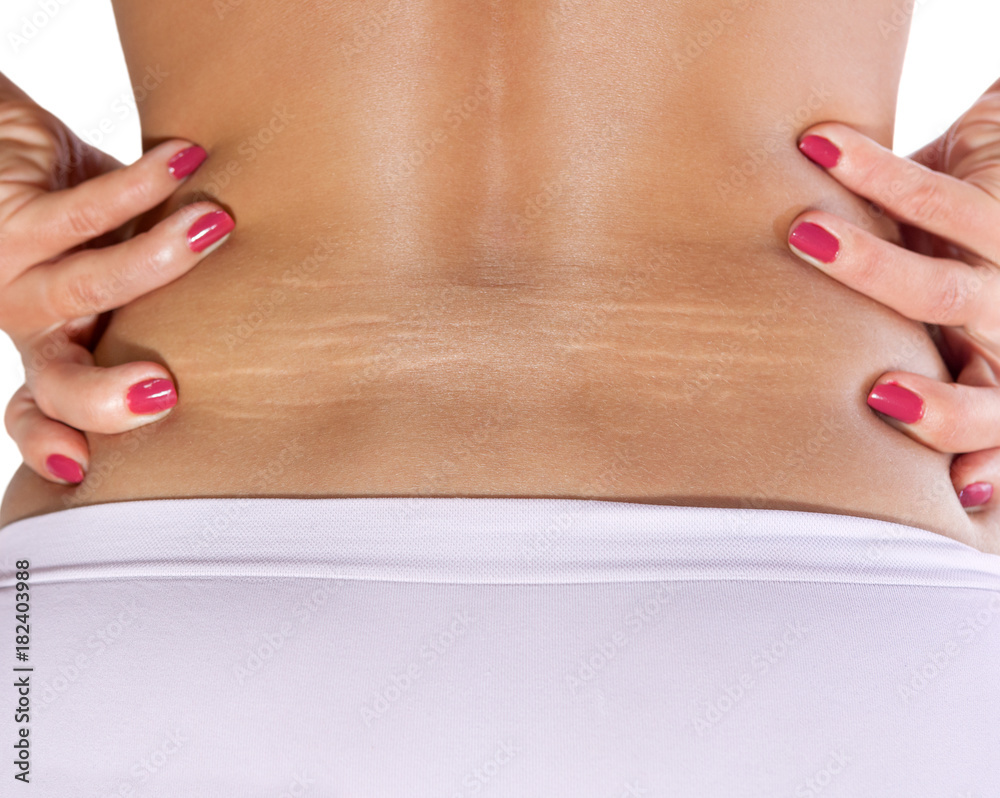 Female lower back with stretch marks Stock Photo