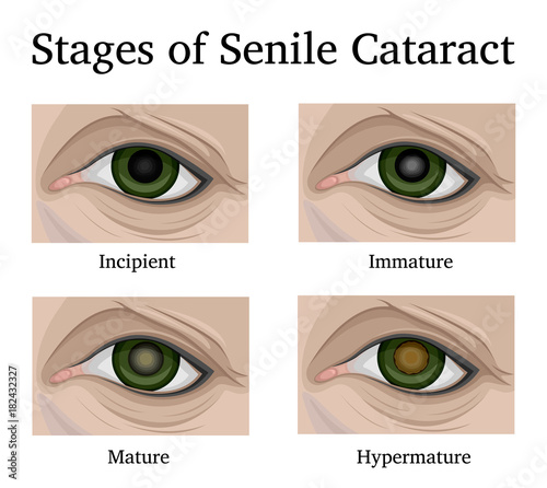 Stages of Senile Cataracts