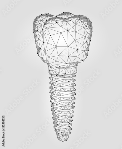 Molar tooth dental implant 3d low poly geometric model. Dentistry innovation future technology titan metal thread. Medical healthy science abstract gray white polygonal point line vector illustration