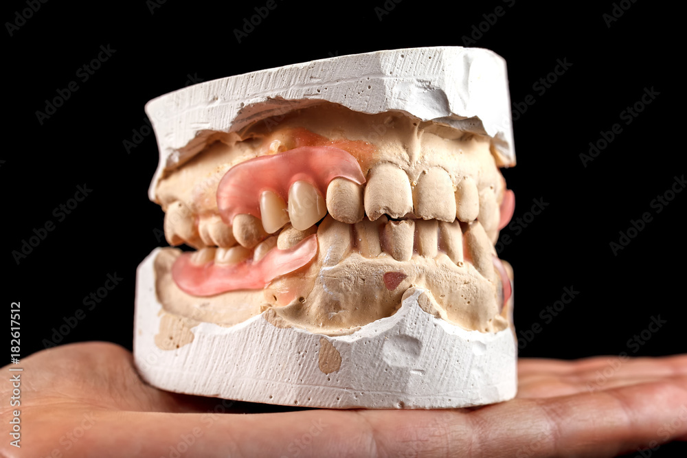 A denture on a gypsum base in the hand of a dentist. A denture on a gypsum base in the hand of a dentist.