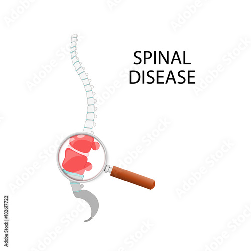 spinal disease. Lumbar section through a magnifying glass.