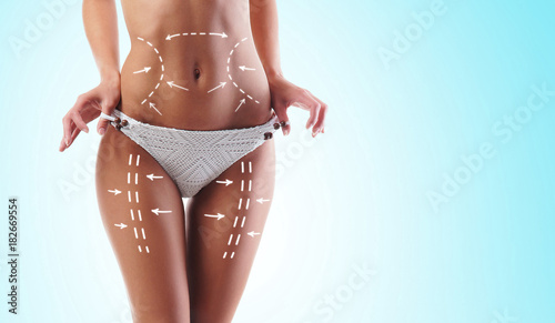 Women slim body in swimwear having arrows along her stomach and legs. Fat lose, liposuction and cellulite removal concept.