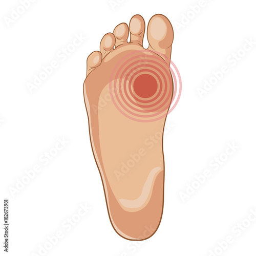 Foot sole illustration. Pain concept.