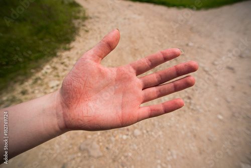 Easily injured hand of a woman after fall in the tourist walk © savelov