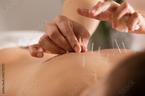 The doctor sticks needles into the girl's body on the acupuncture - close up photo