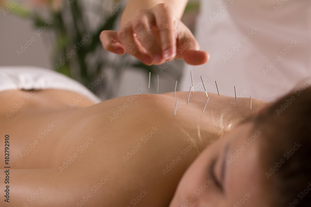 The doctor sticks needles into the girl's body on the acupuncture - obrazy, fototapety, plakaty 