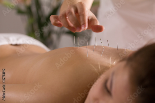 The doctor sticks needles into the girl's body on the acupuncture