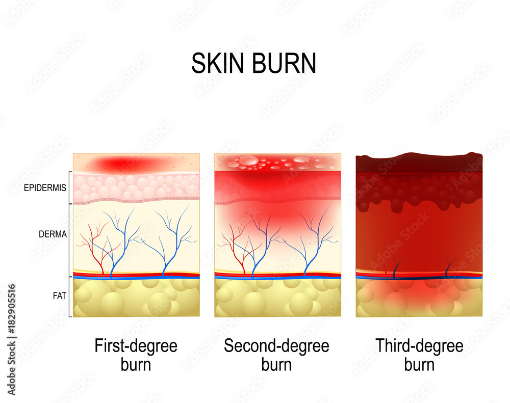 skin burn. Three degrees of burns. Stock Vector Adobe Stock