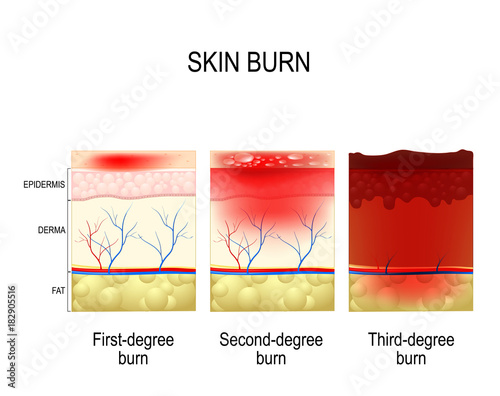 skin burn. Three degrees of burns.