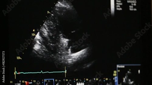 Doctor examining a patient's heart. Echocardiogram