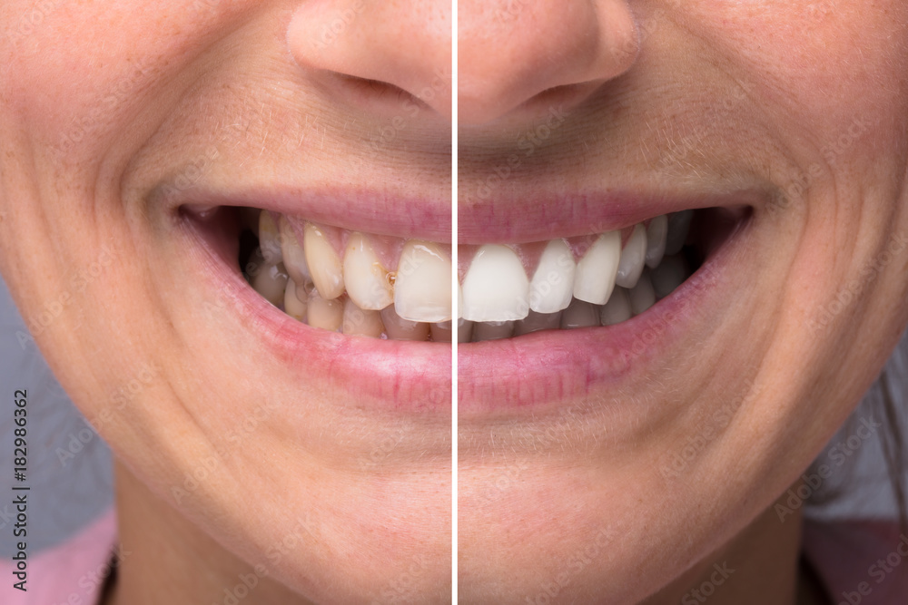 Obraz premium Person Teeth Before And After Whitening
