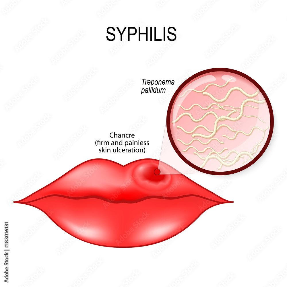 syphilis chancre