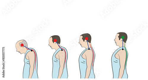 Development of a stooped stance with age, showing increasing curvature of the spine

