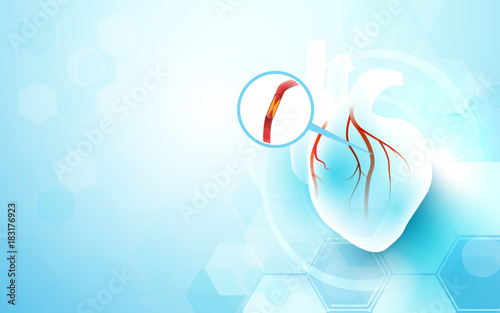 Abstract geometric with medicine and science concept background. Myocardial infarction. Heart attack. Blocked artery