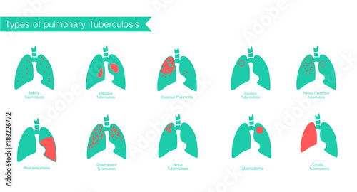 Types of tuberculosis. Vector silhouette medical 