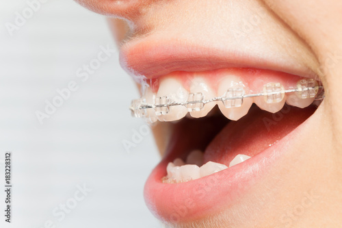 Orthodontics correction of jaws with clear bracket photo