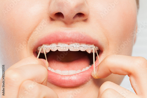 Close-up of woman wearing orthodontic elastic band photo