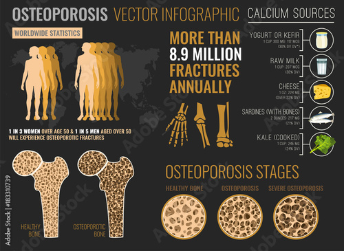 Osteoporosis Infographic Poster